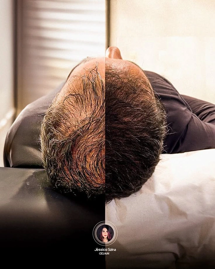 Hair Transplant & Hair Clinics creative ad: Split before/after on one head