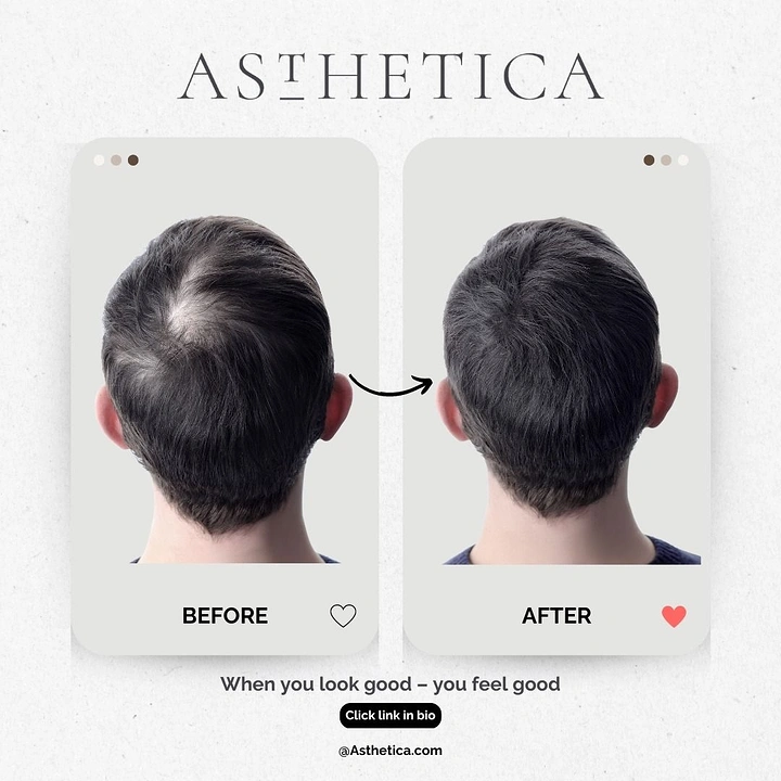 Hair Transplant & Hair Clinics creative ad: Before-after as social media post cards
