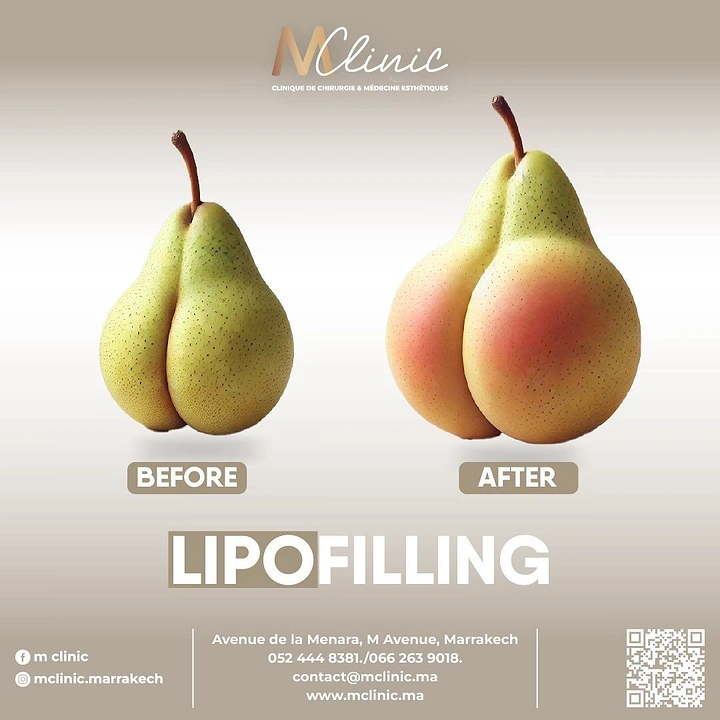 Plastic Surgery Clinics creative ad: Pears cleverly visualize lipofilling results