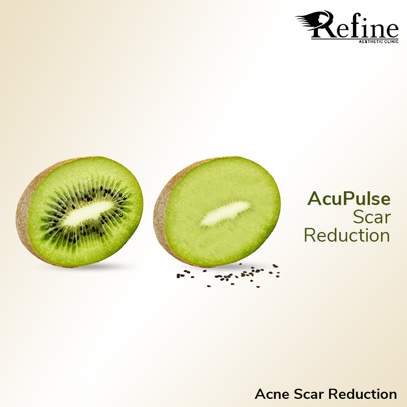 Instagram post: Kiwi scarred to smooth, acne metaphor