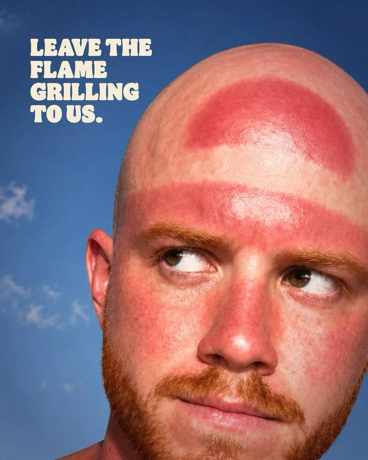 Fast Food creative ad: Bald man whose sunburn is shaped like a burger bun