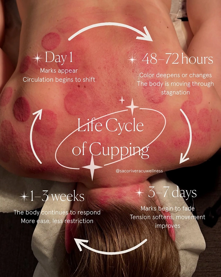 Acupuncture & Cupping Clinics creative ad: Healing timeline cycle drawn on marked back