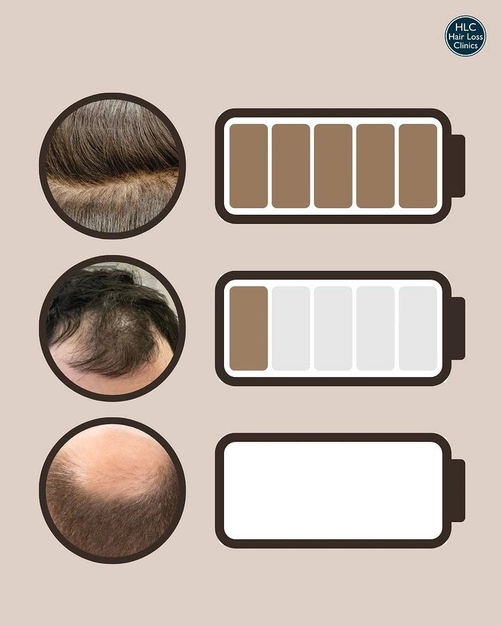 Hair Transplant & Hair Clinics creative ad: Battery levels as hair density metaphor