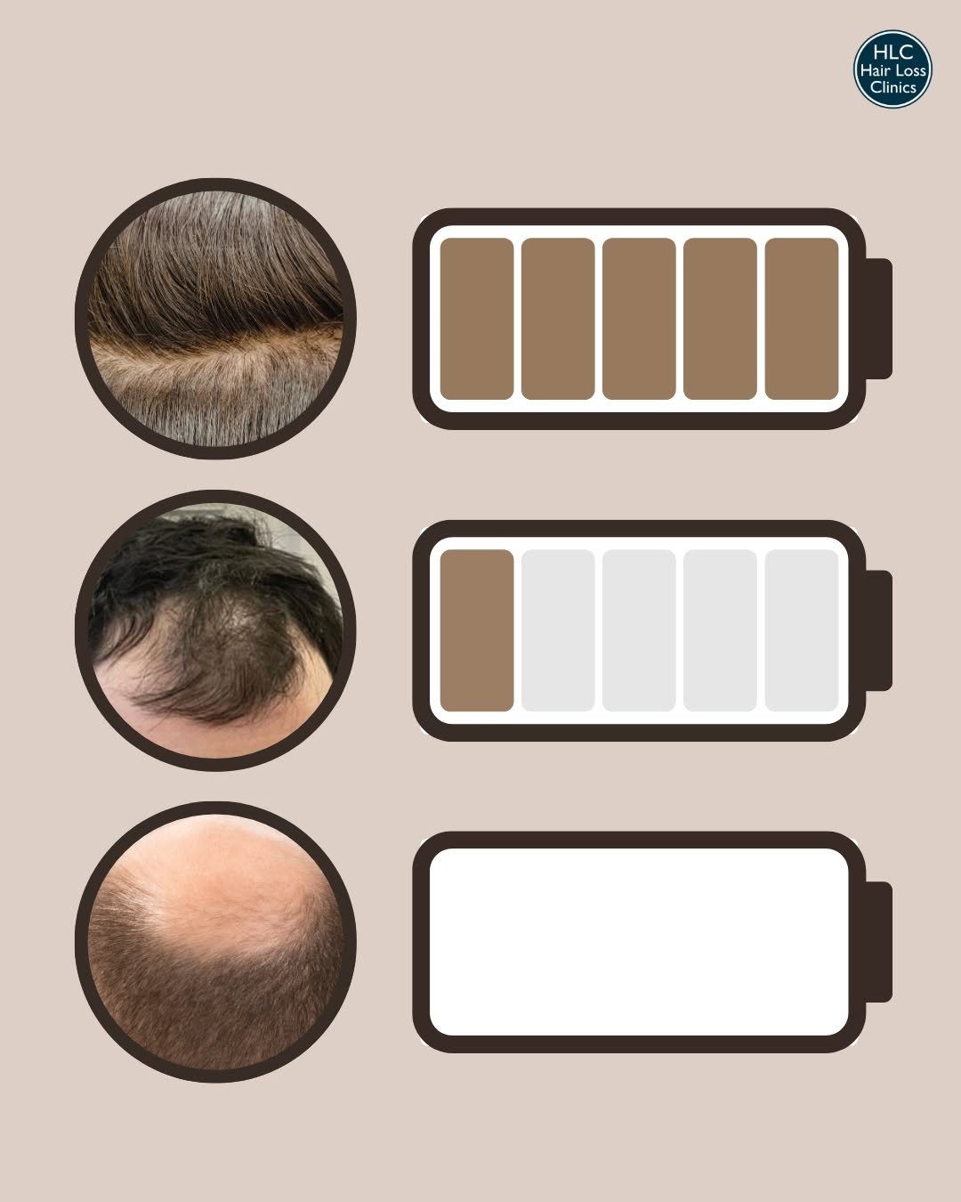 Instagram post: Battery levels as hair density metaphor