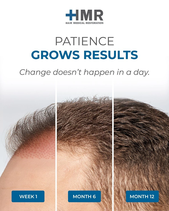 Hair Transplant & Hair Clinics creative ad: Split timeline growth, patience grows results