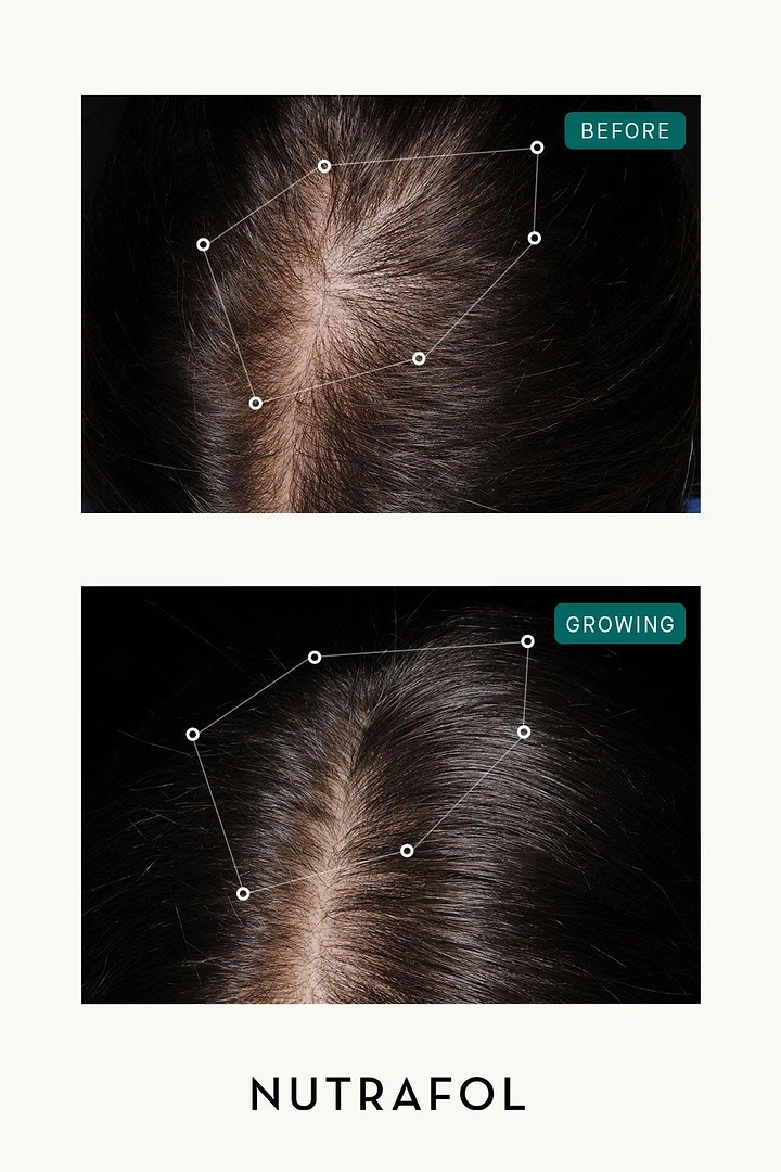 Hair Transplant & Hair Clinics creative ad: Scalp dots as constellation before/after