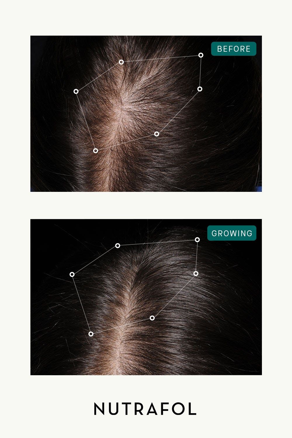 Story: Scalp dots as constellation before/after
