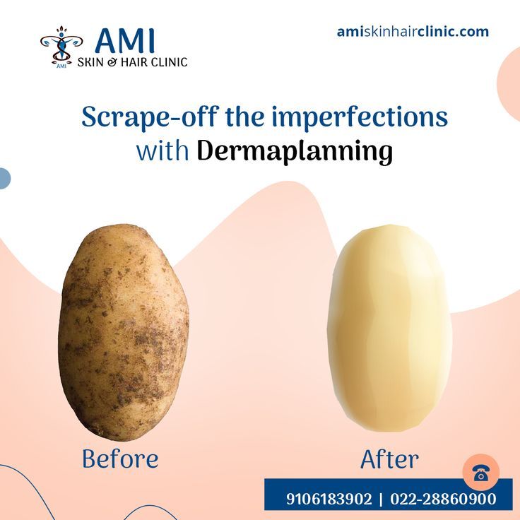 Instagram post: Peeled potato as dermaplaning before-after